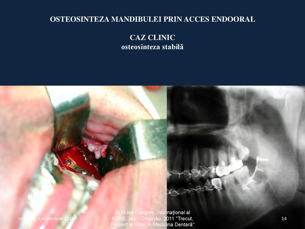 Osteosinteza mandibulei prin acces endooral CAZ CLINIC osteosinteza stabilă