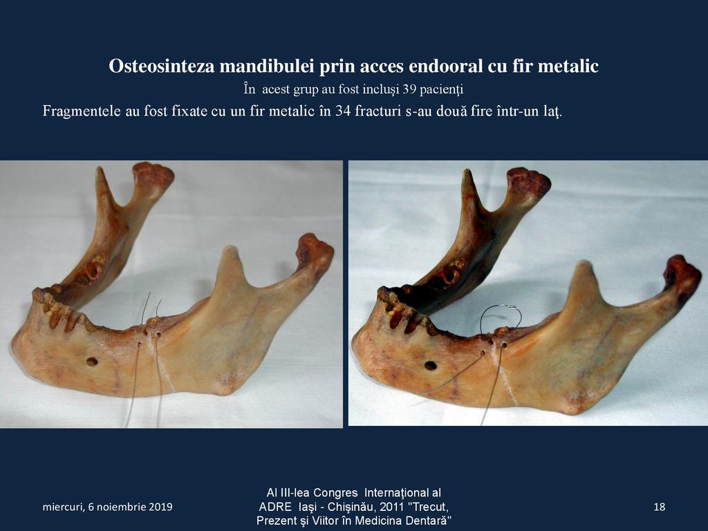 Osteosinteza mandibulei prin acces endooral cu fir metalic