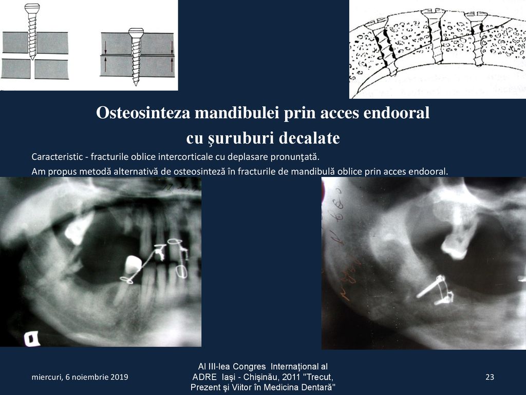 Osteosinteza mandibulei prin acces endooral
