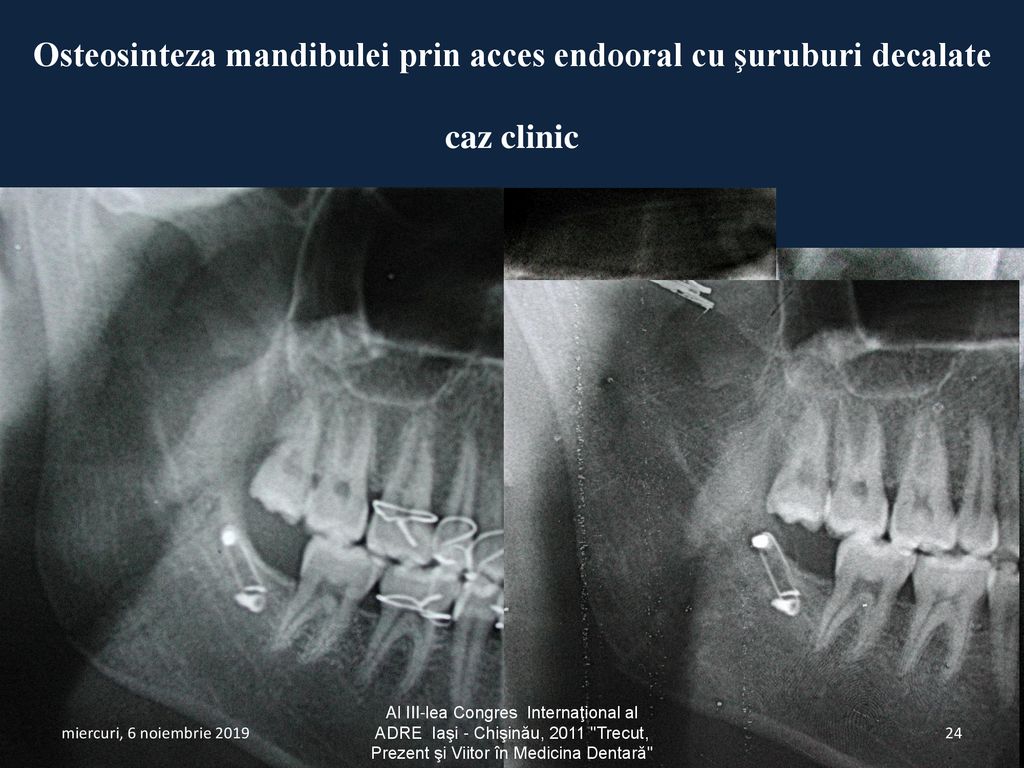 Osteosinteza mandibulei prin acces endooral cu şuruburi decalate caz clinic