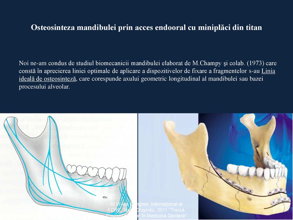 Osteosinteza mandibulei prin acces endooral cu miniplăci din titan
