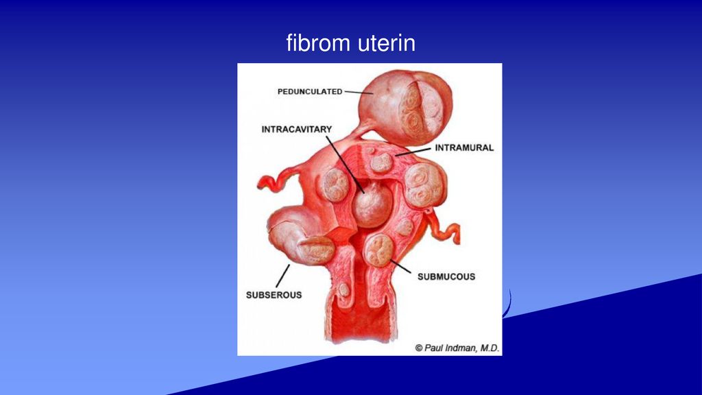 fibrom uterin