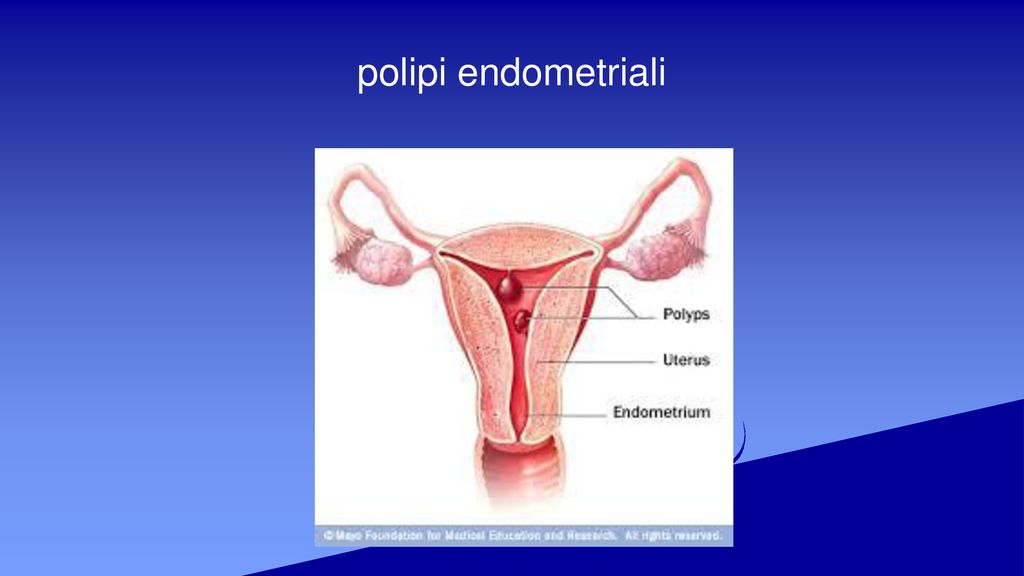 polipi endometriali